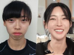 kim min ji plastic surgery rumors