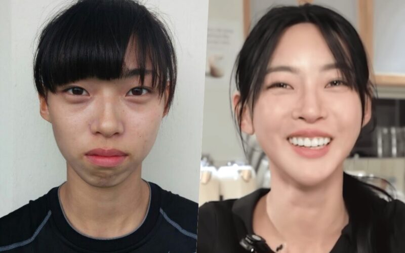 kim min ji plastic surgery rumors